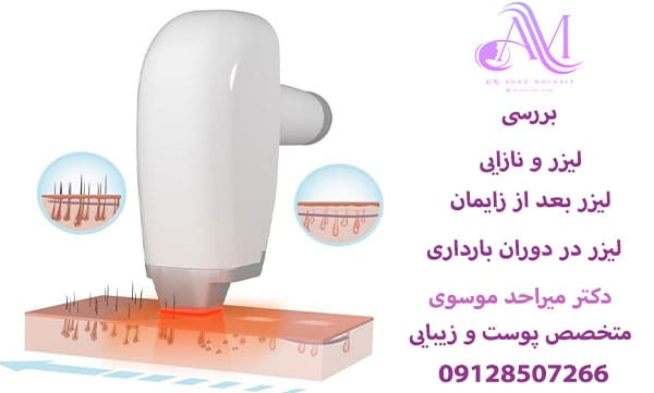 لیزر و نازایی