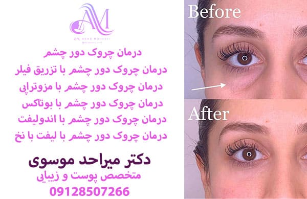 درمان چروک دور چشم