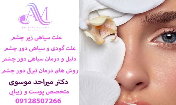 علت سیاهی دور چشم