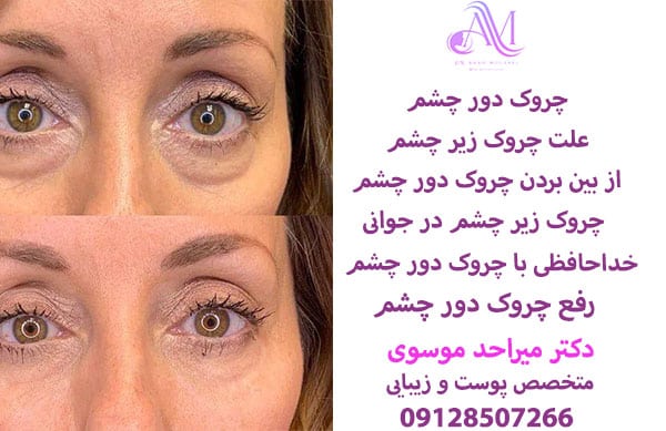 رفع چروک دور چشم