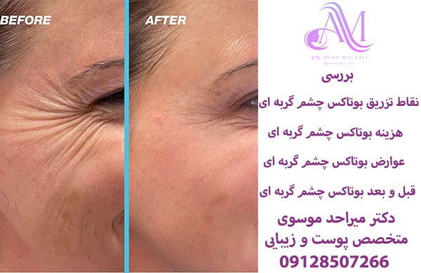 هزینه بوتاکس چشم گربه ای