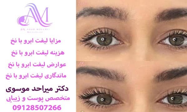 لیفت ابرو با نخ