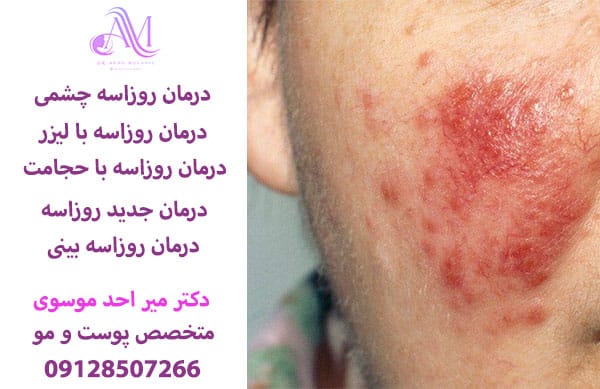 درمان روزاسه چشمی