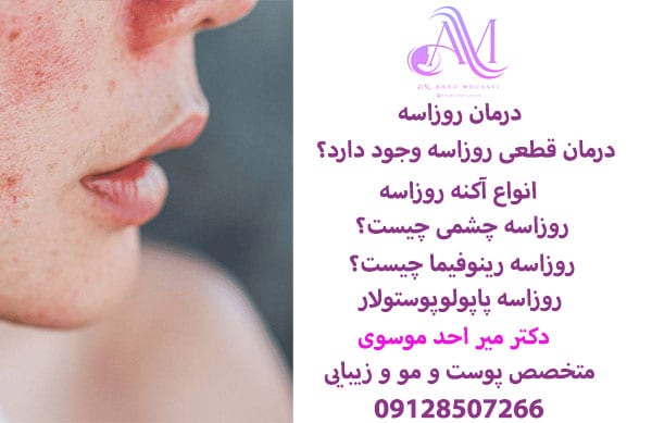 درمان روزاسه