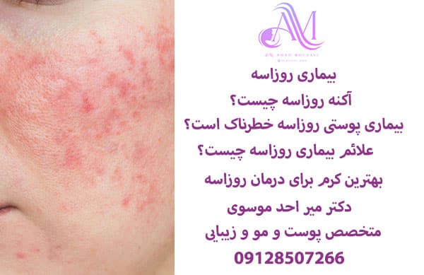 بیماری روزاسه