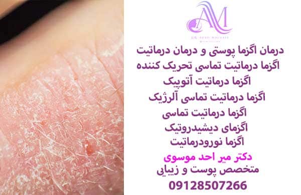درمان اگزما و درمان درماتیت