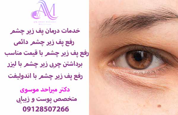 رفع پف زیر چشم دائمی