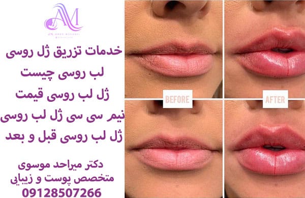 تزریق ژل لب روسی