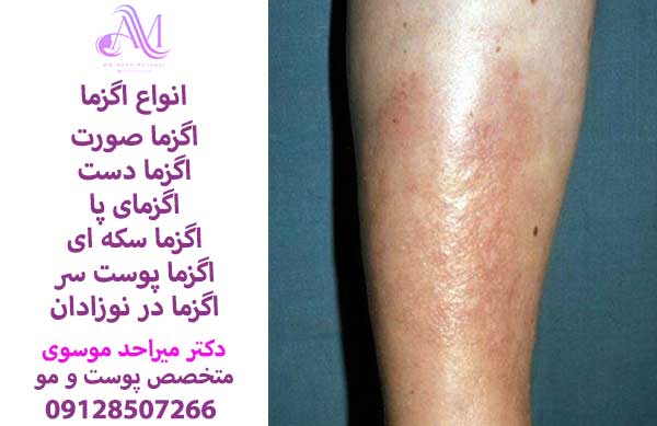 علل ایجاد اگزما