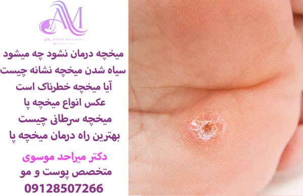 درمان میخچه