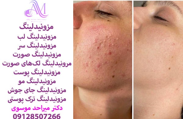 مزونیدلینگ