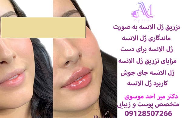 عکی واقعی از تزریق فیلر الانسه به صورت در کلینیک دکتر احد موسوی