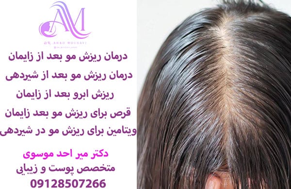 درمان ریزش مو بعد از زایمان