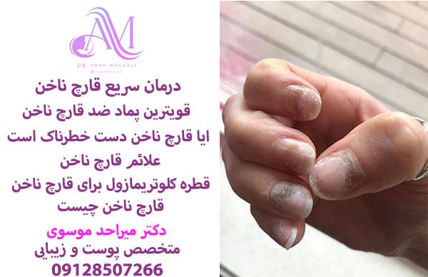 درمان قارچ ناخن