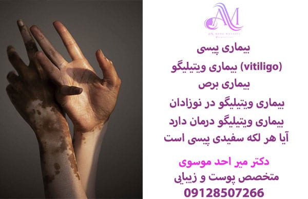 بیماری پیسی یا ویتیلیگو یا برص