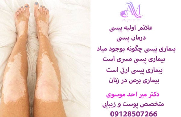 درمان ویتیلیگو یا پیسی