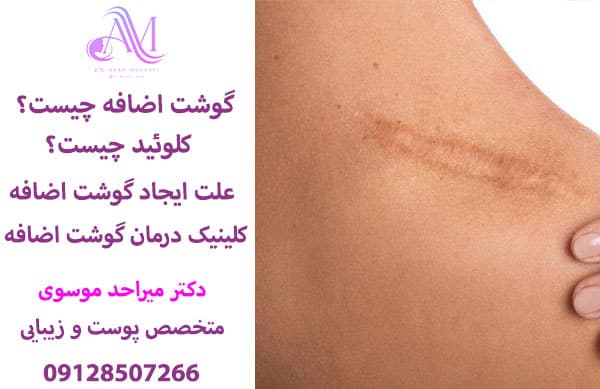 گوشت اضافه یا کلوئید چیست