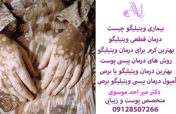بیماری ویتیلیگو چیست