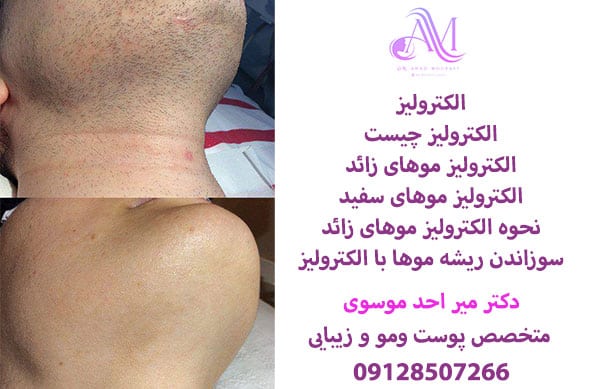 الکترولیز موهای زائد