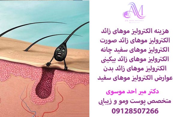 الکترولیز موهای سفید