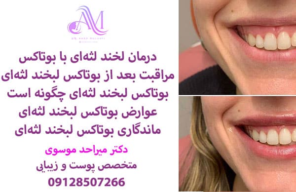 درمان لبخند لثه ای با بوتاکس
