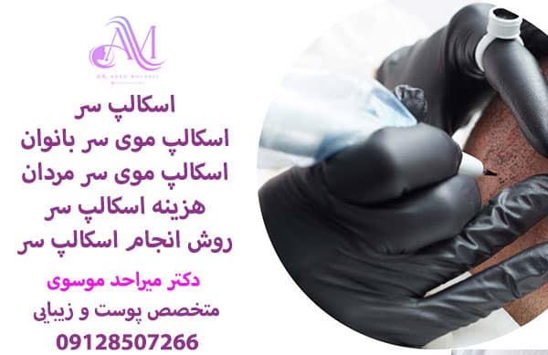 اسکالپ سر