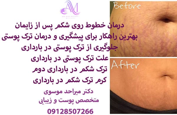 ترک شکم در بارداری