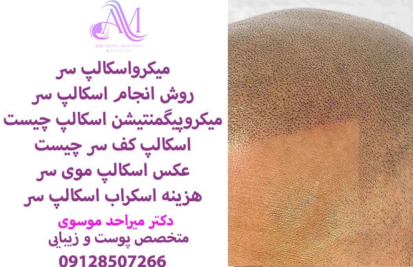 میکرواسکالپ سر