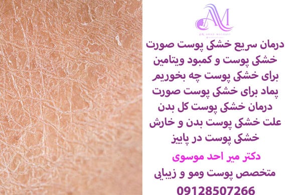 درمان خشکی پوست بدن