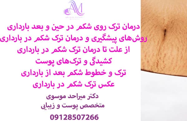 درمان ترک شکم در بارداری