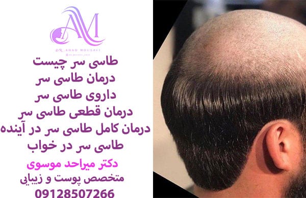 درمان طاسی سر