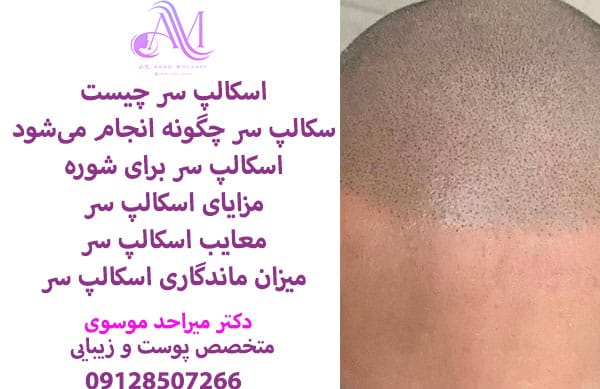 اسکالپ سر چیست