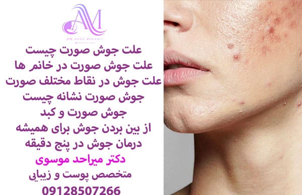 علت جوش صورت