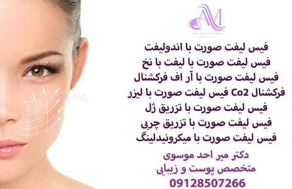 فیس لیفت صورت با اندولیفت