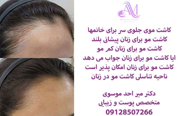 کاشت موی جلوی سر بانوان