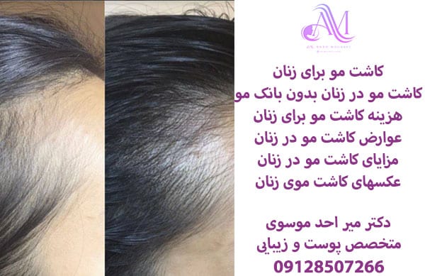 کاشت مو برای زنان