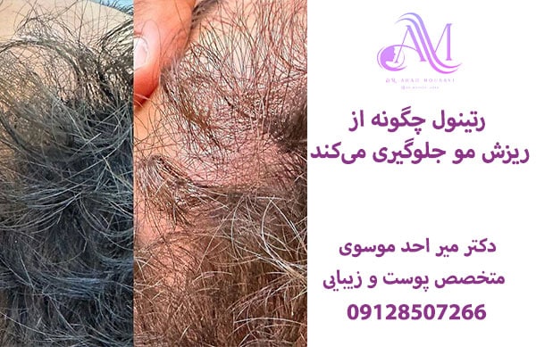 رتینول چگونه از ریزش مو جلوگیری میکند