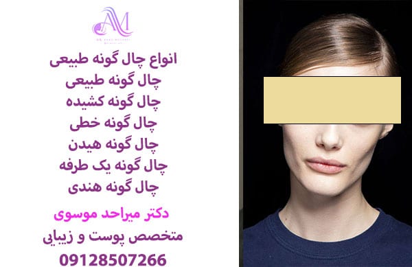 چال گونه با نخ