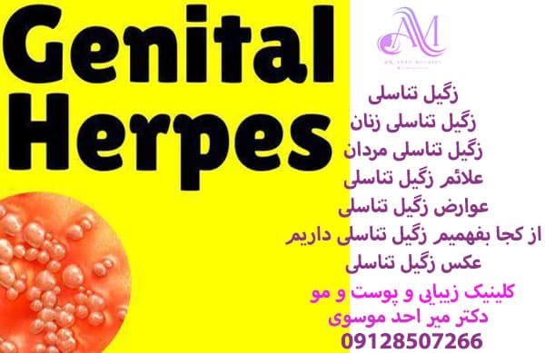 زگیل تناسلی