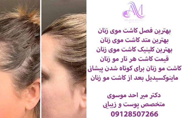 بهترین کلینیک کاشت موی بانوان