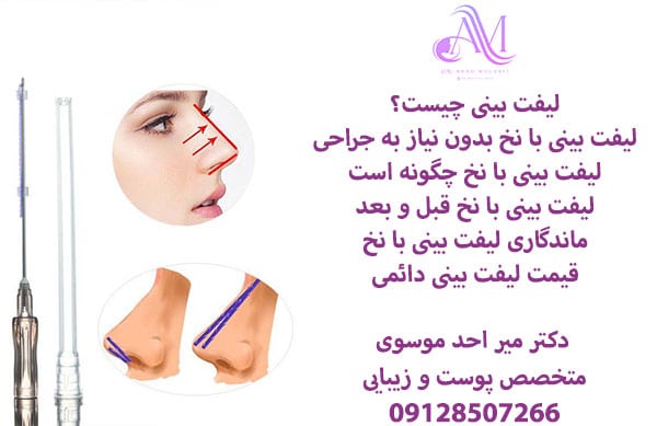 قیمت لیفت بینی با نخ