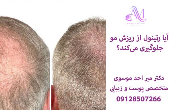 آیا رتینول از ریزش مو جلوگیری میکند