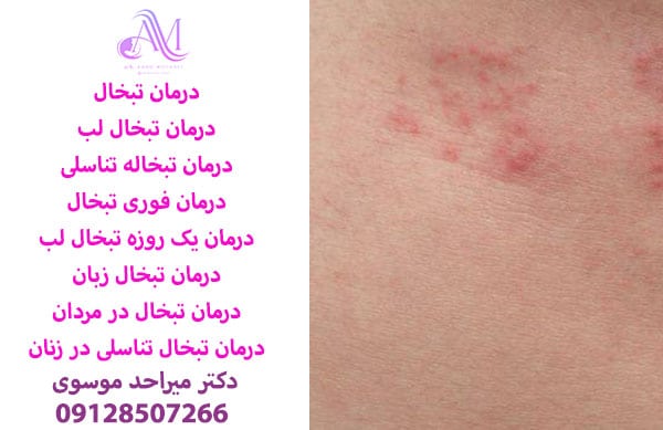 درمان نبخال