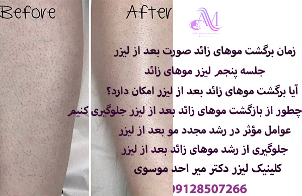 چطور از بازگشت موهای زائد بعد از لیزر جلوگیری کنیم