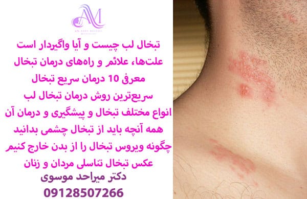 تبخال تناسلی