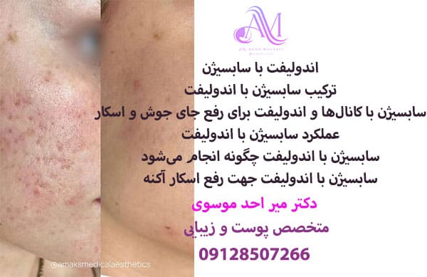 اندولیفت با سابسیژن