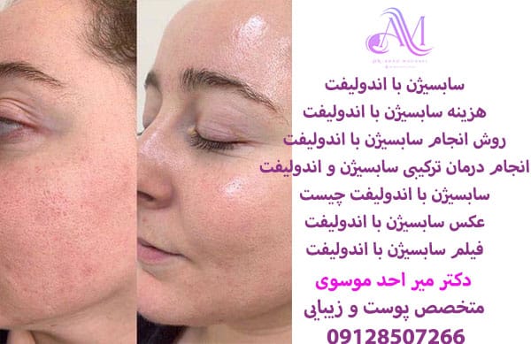 سابسیژن با اندولیفت