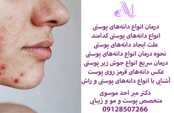 درمان انواع دانههای پوستی