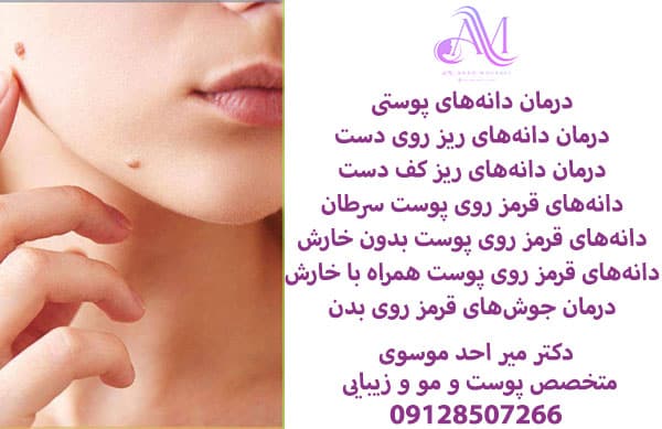 درمان دانههای ریز روی دست