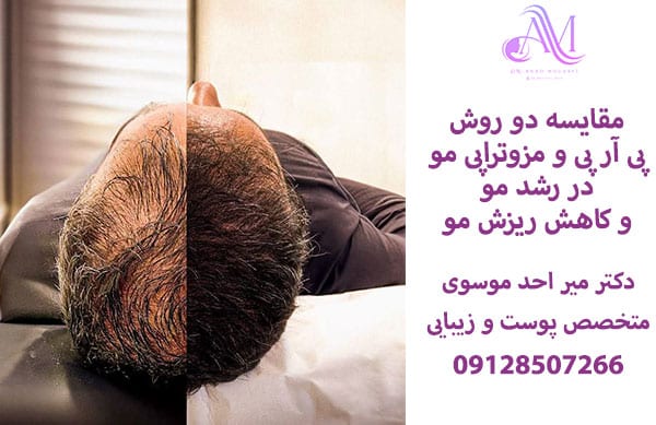 مقایسه پی ار پی و مزوتراپی